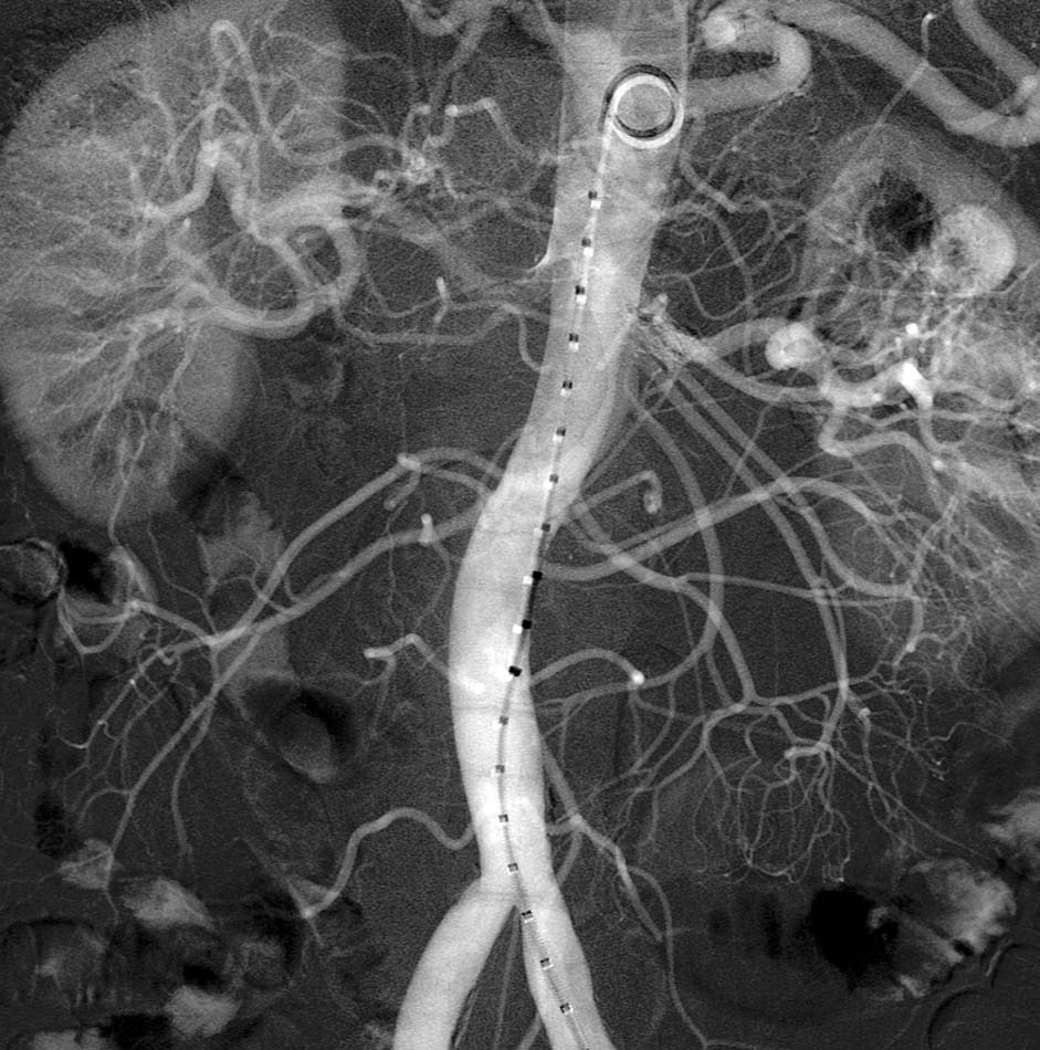 Abdominal aorta and SMA angiogram (x-ray)