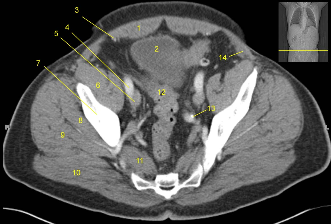 Pelvis computed tomograph (axial CT)